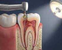 save-your-natural-teeth-with-expert-root-canal-care