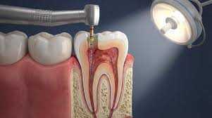 save-your-natural-teeth-with-expert-root-canal-care-big-0