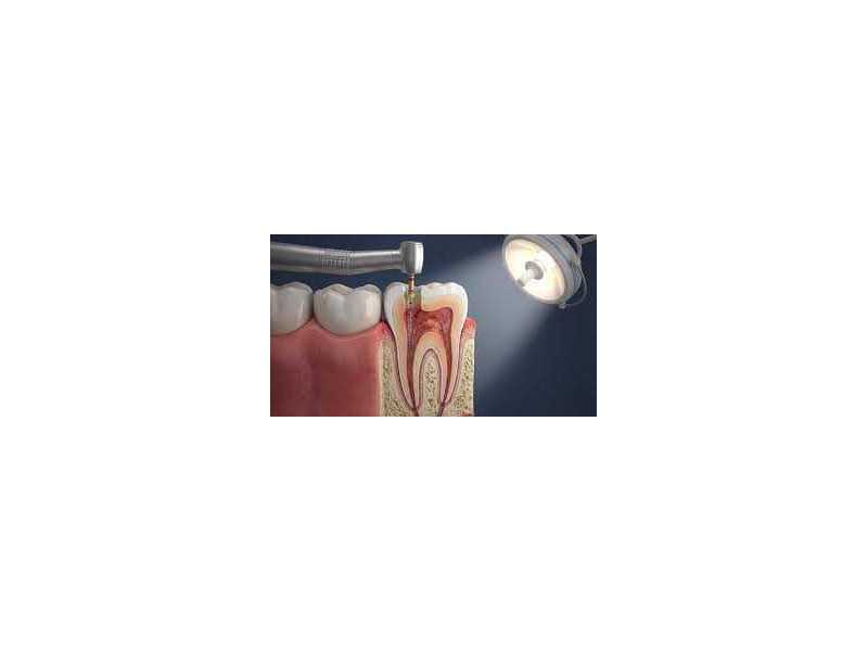 save-your-natural-teeth-with-expert-root-canal-care-small-0