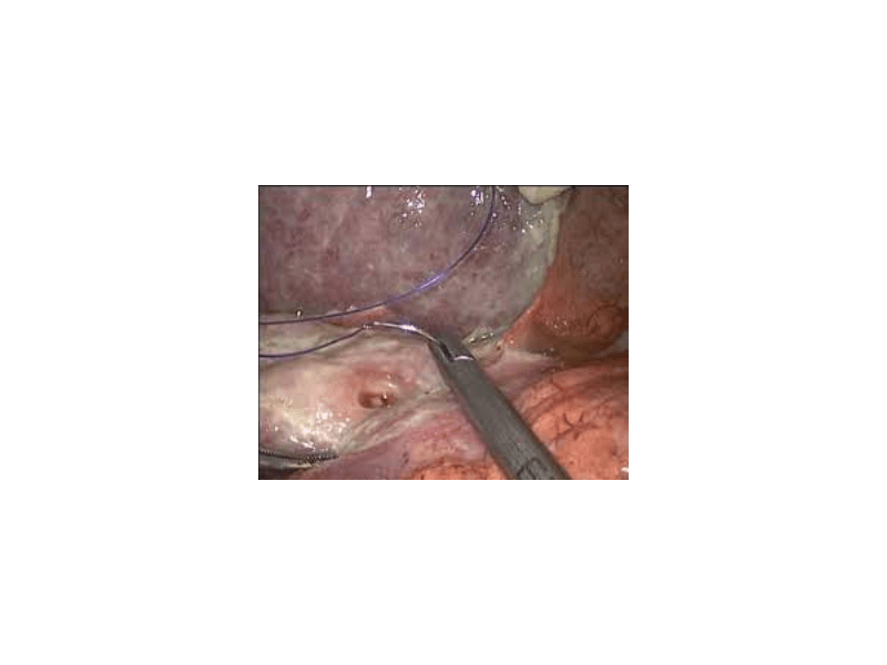 advanced-gastrointestinal-tumor-treatment-by-experienced-specialists-small-0