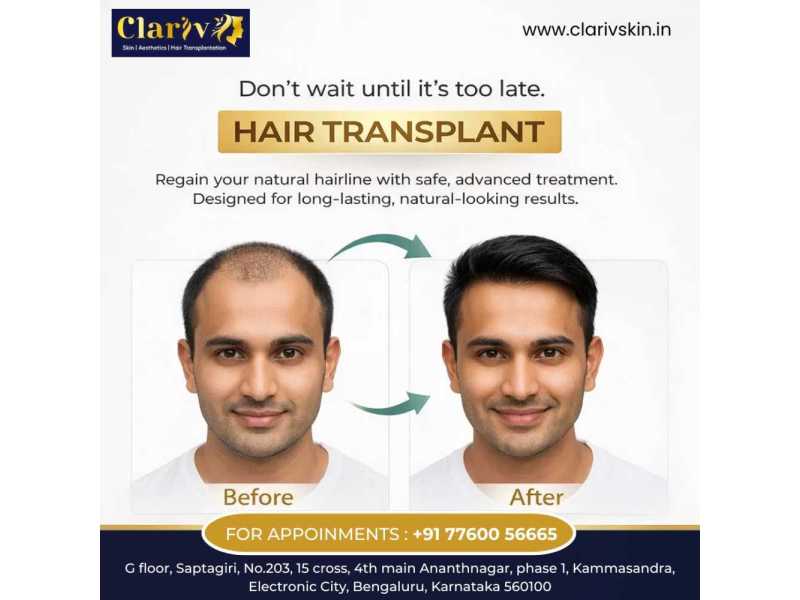 best-hair-transplant-clinic-in-electronic-city-small-0