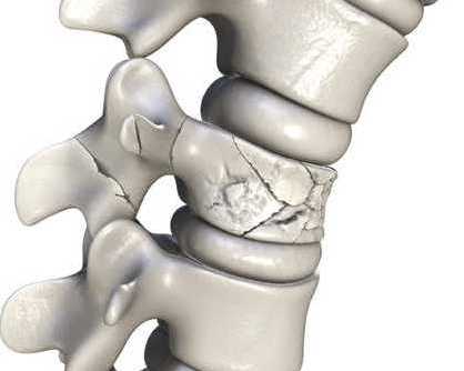 spinal-fracture-treatment-recovery-in-mumbai-zen-spine