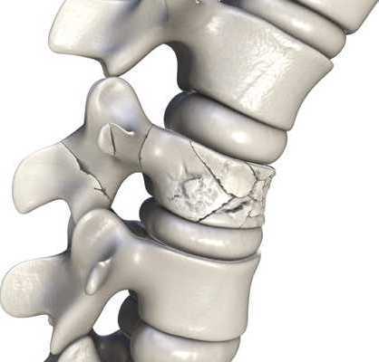 spinal-fracture-treatment-recovery-in-mumbai-zen-spine-big-0
