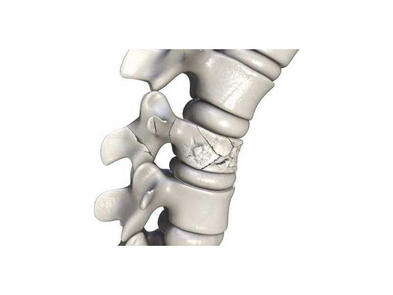 spinal-fracture-treatment-recovery-in-mumbai-zen-spine-small-0