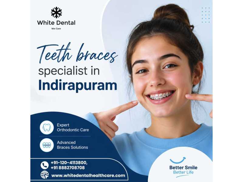 teeth-braces-specialist-in-indirapuram-for-better-smile-alignment-small-0