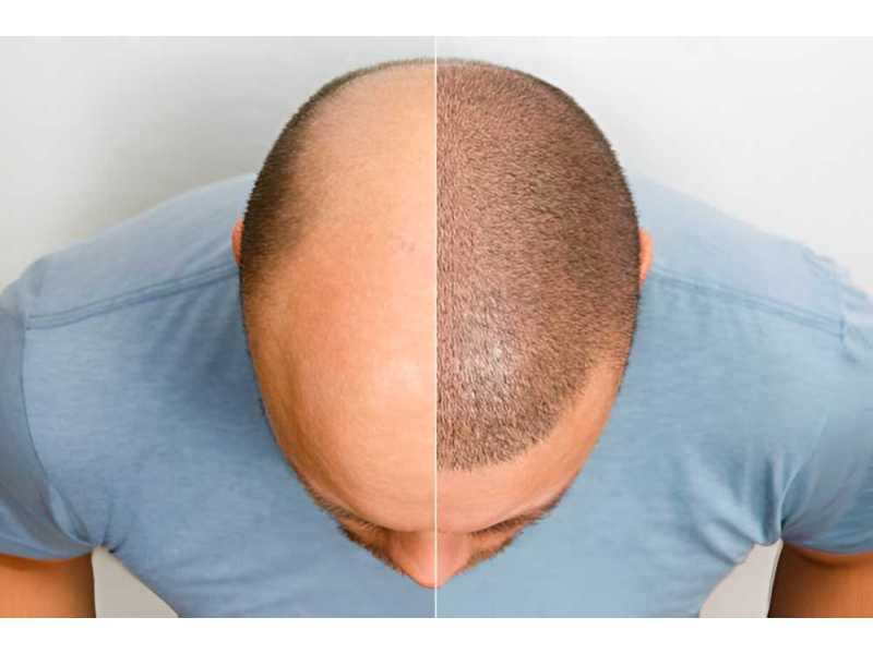 how-to-choose-the-best-hair-transplant-in-varanasi-small-0