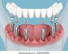 restore-your-smile-with-advanced-dental-implant-care