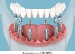 restore-your-smile-with-advanced-dental-implant-care-big-0