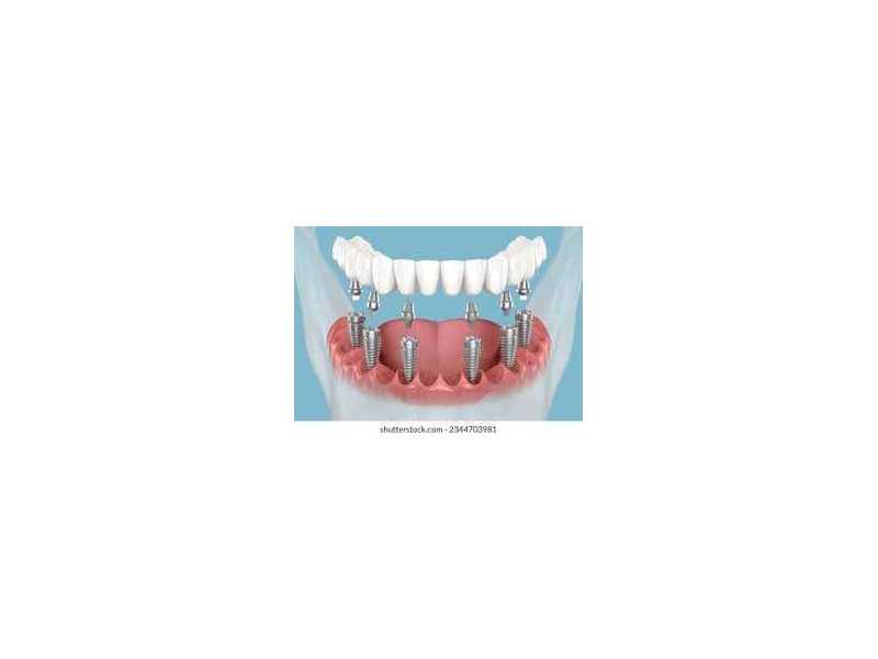 restore-your-smile-with-advanced-dental-implant-care-small-0
