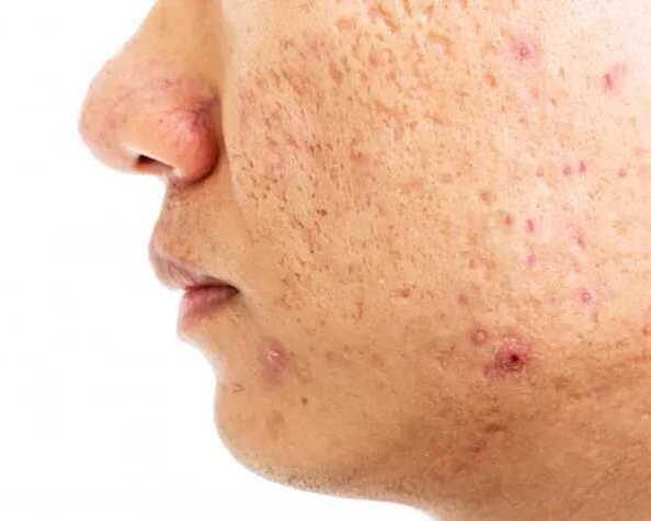 best-acne-scar-treatment-in-delhi-by-expert-dermatologists