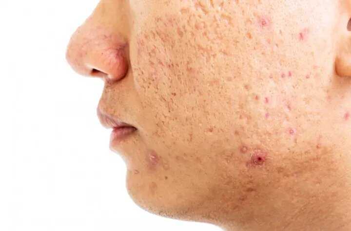 best-acne-scar-treatment-in-delhi-by-expert-dermatologists-big-0
