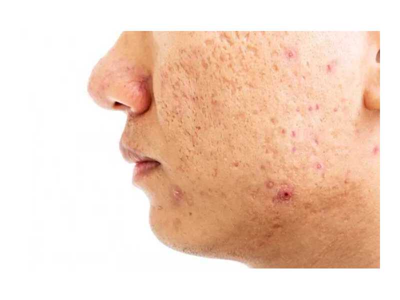 best-acne-scar-treatment-in-delhi-by-expert-dermatologists-small-0