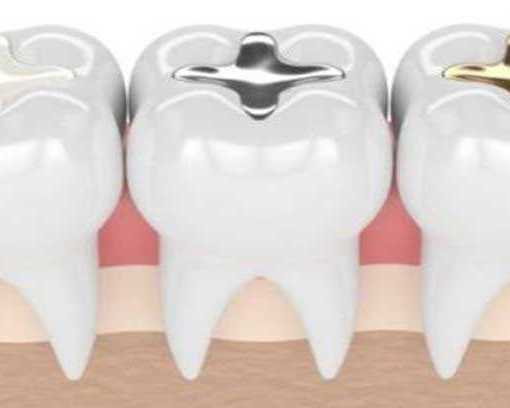 best-teeth-gap-cavity-filling-treatment-in-coimbatore