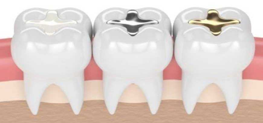best-teeth-gap-cavity-filling-treatment-in-coimbatore-big-0