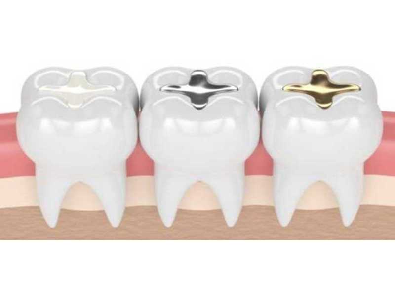 best-teeth-gap-cavity-filling-treatment-in-coimbatore-small-0