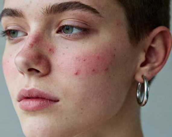 acne-laser-treatment-in-gurgaon-by-dr-shilpi-bhadani