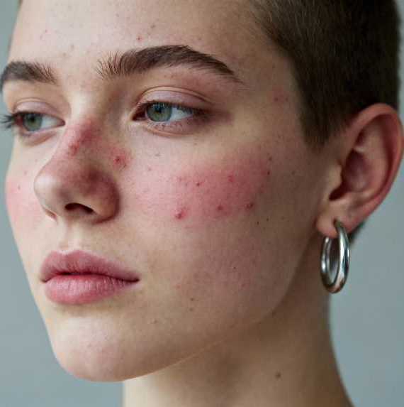 acne-laser-treatment-in-gurgaon-by-dr-shilpi-bhadani-big-0