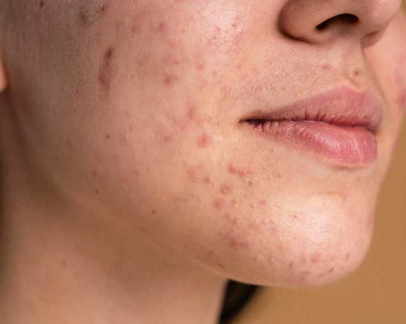 what-causes-acne-and-how-can-it-be-effectively-treated
