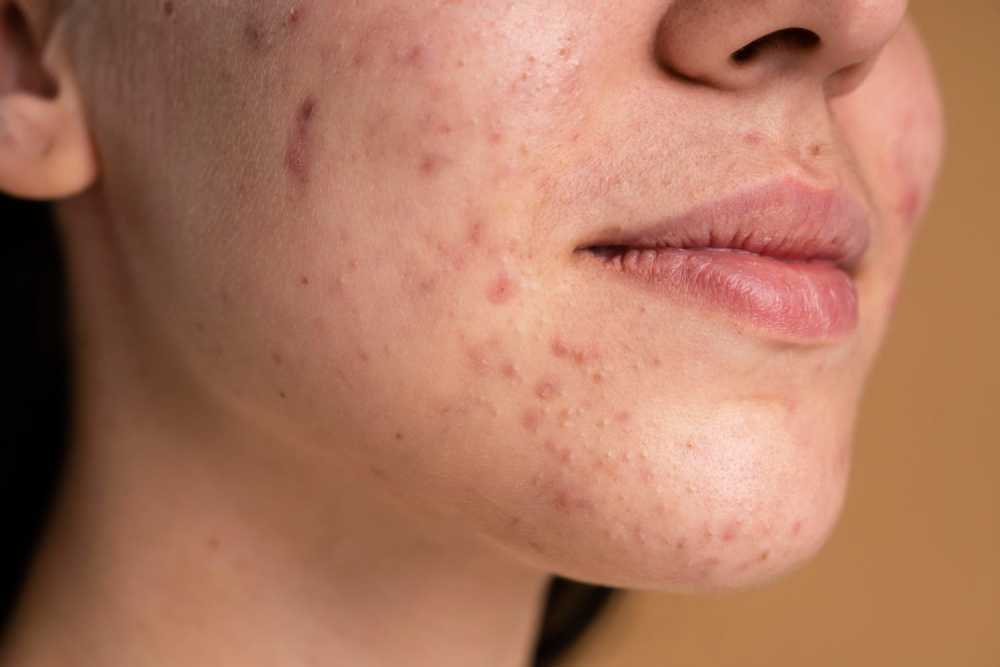what-causes-acne-and-how-can-it-be-effectively-treated-big-0