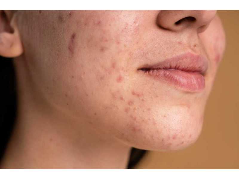 what-causes-acne-and-how-can-it-be-effectively-treated-small-0