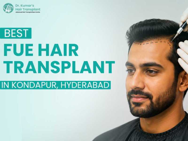 fue-hair-transplant-in-hyderabad-with-advanced-techniques-small-0