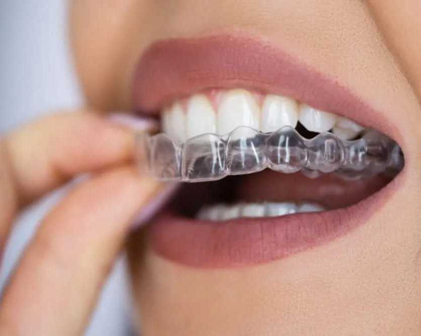clear-aligner-treatment-noida-for-a-perfect-smile