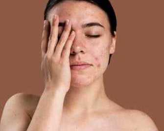 best-acne-treatment-in-greater-noida-dermalinks-clinic
