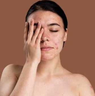 best-acne-treatment-in-greater-noida-dermalinks-clinic-big-0