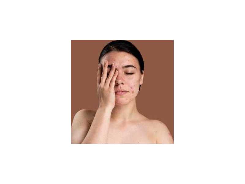 best-acne-treatment-in-greater-noida-dermalinks-clinic-small-0
