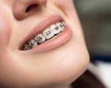 best-dental-brace-in-chetla-for-a-perfect-smile