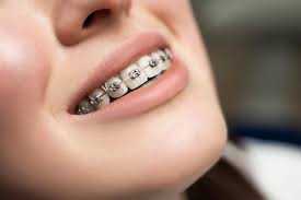 best-dental-brace-in-chetla-for-a-perfect-smile-big-0