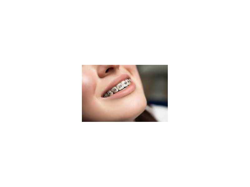 best-dental-brace-in-chetla-for-a-perfect-smile-small-0