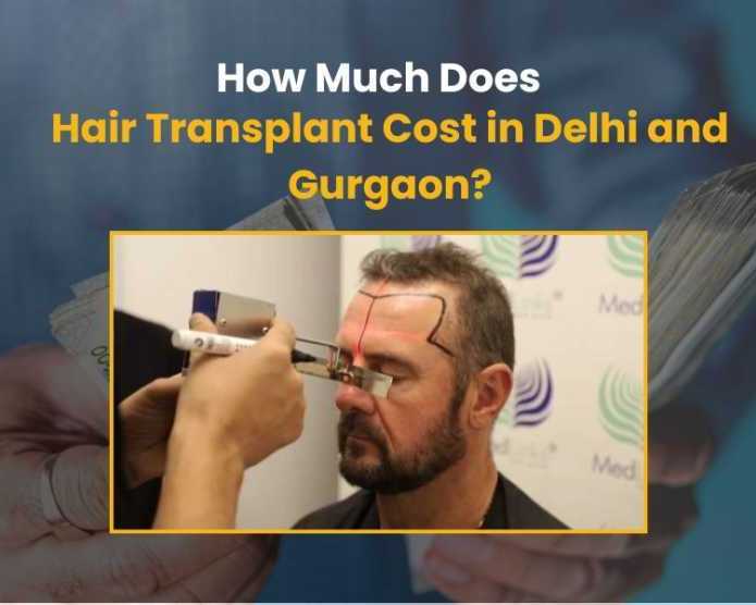 cost-of-hair-transplant-in-delhi-medlinks-hair-transplant