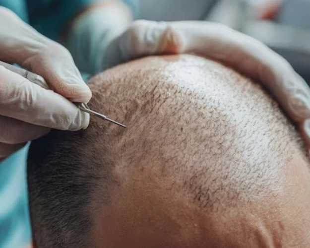 hair-transplant-in-delhi-with-affordable-cost-langersculpt