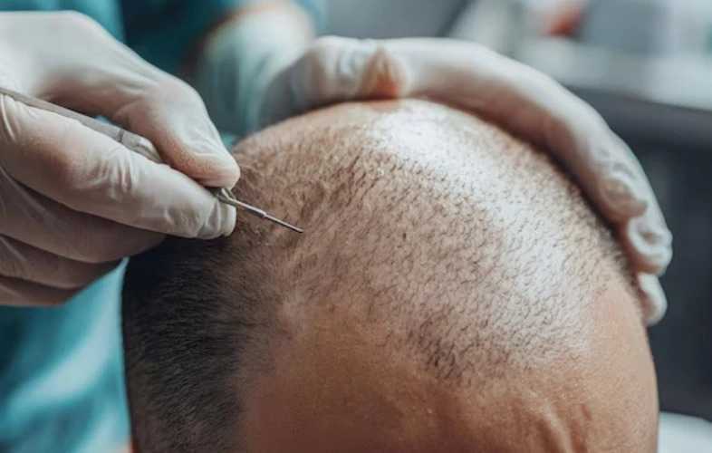 hair-transplant-in-delhi-with-affordable-cost-langersculpt-big-0