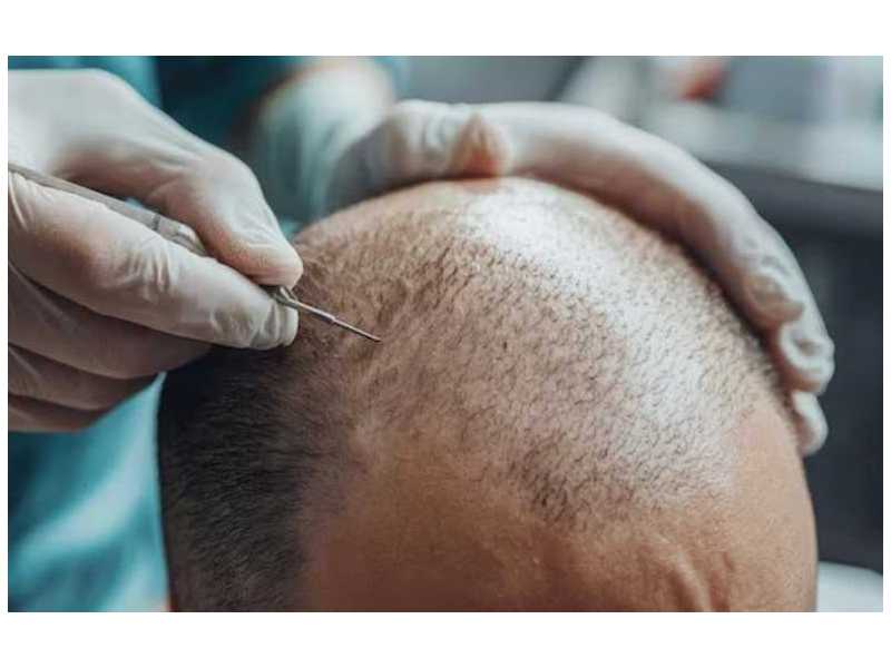 hair-transplant-in-delhi-with-affordable-cost-langersculpt-small-0
