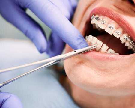 braces-treatment-in-nibm-pune-expert-orthodontist-affordable-braces