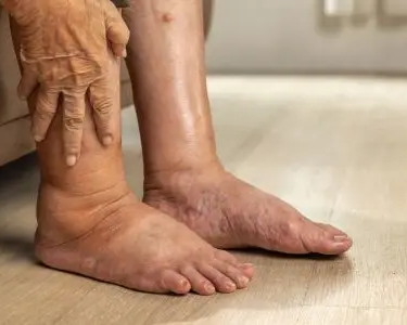swelling-in-feet-face-ankles