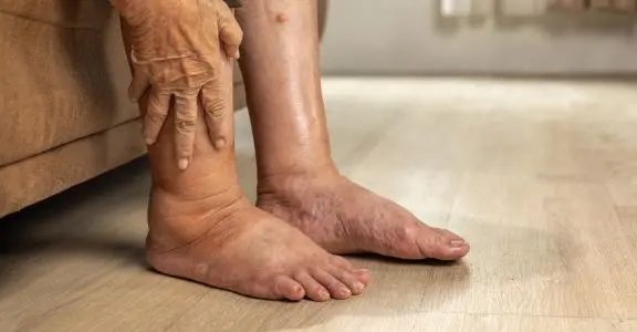 swelling-in-feet-face-ankles-big-0