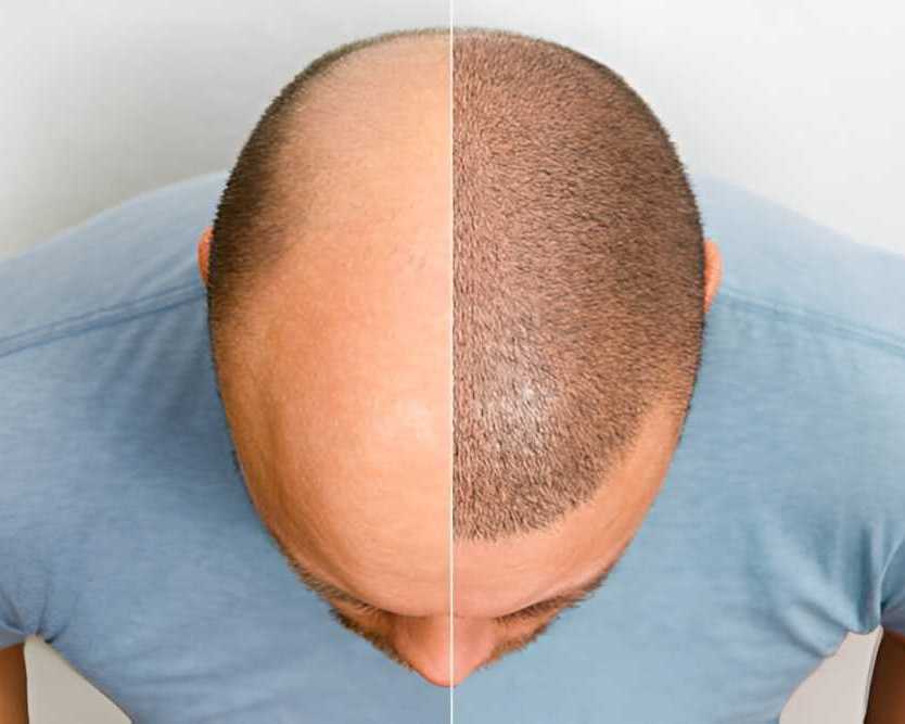 how-to-choose-the-best-hair-transplant-in-bhopal-for-lasting-results
