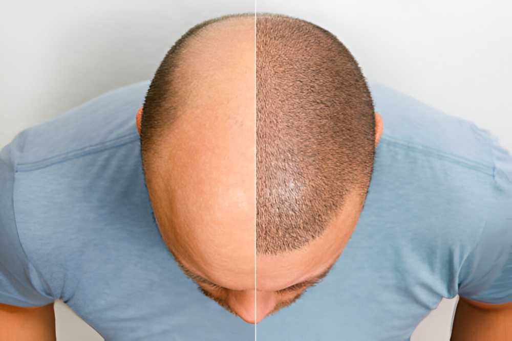 what-defines-the-best-hair-transplant-clinic-for-successful-hair-big-0