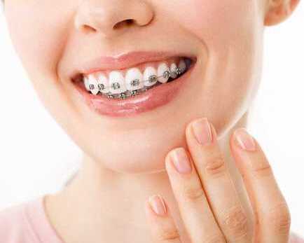 affordable-braces-treatment-in-pune-from-rs29999-emi-available
