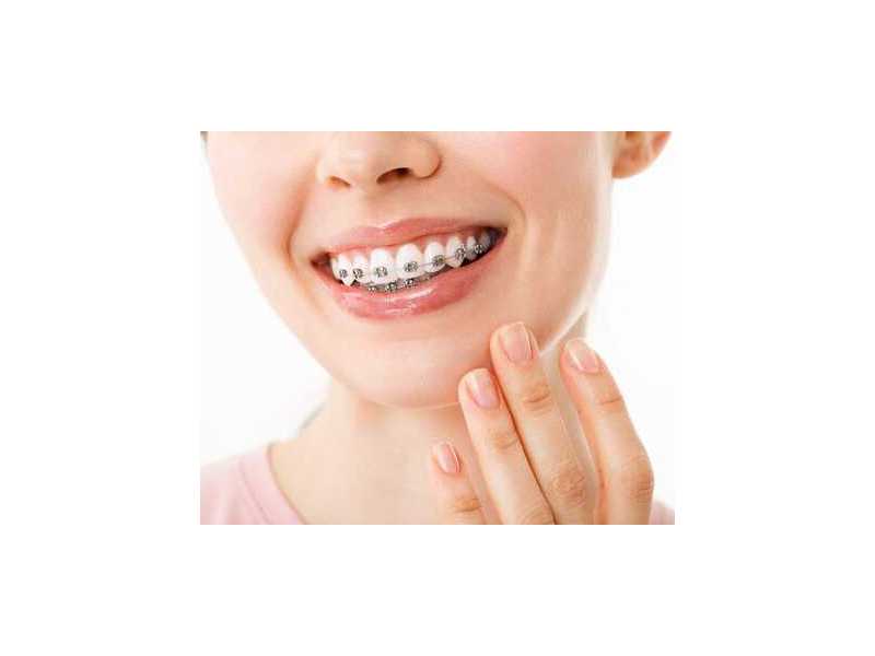 affordable-braces-treatment-in-pune-from-rs29999-emi-available-small-0