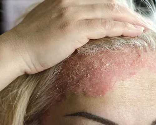 eczema-rash-treatment-expert-care-for-healthy-skin