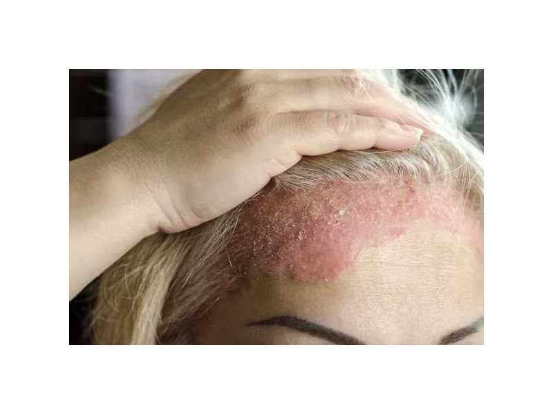 eczema-rash-treatment-expert-care-for-healthy-skin-small-0