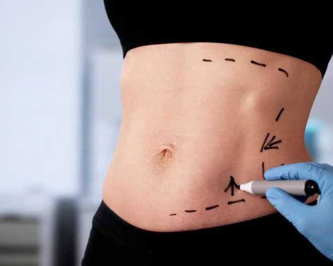 advanced-abdominoplasty-in-mumbai-natural-results