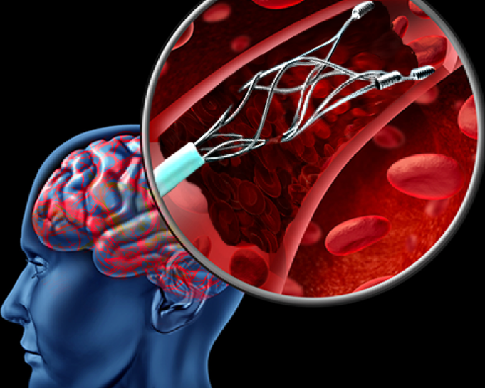 stenting-treatment-ahmedabad-with-advanced-diagnostic-support