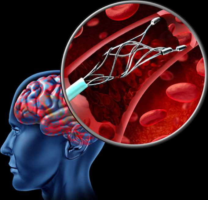 stenting-treatment-ahmedabad-with-advanced-diagnostic-support-big-0