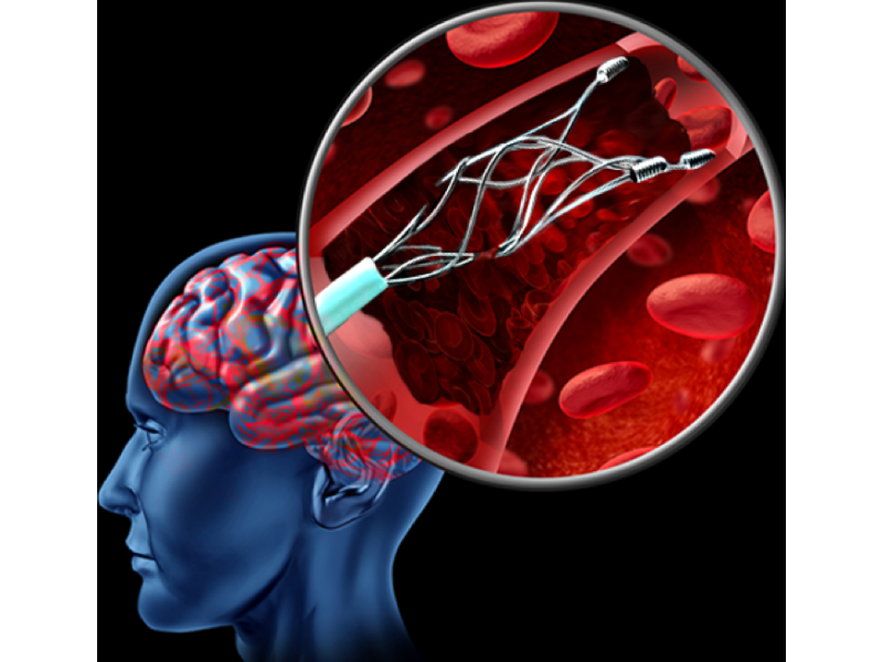 stenting-treatment-ahmedabad-with-advanced-diagnostic-support-small-0