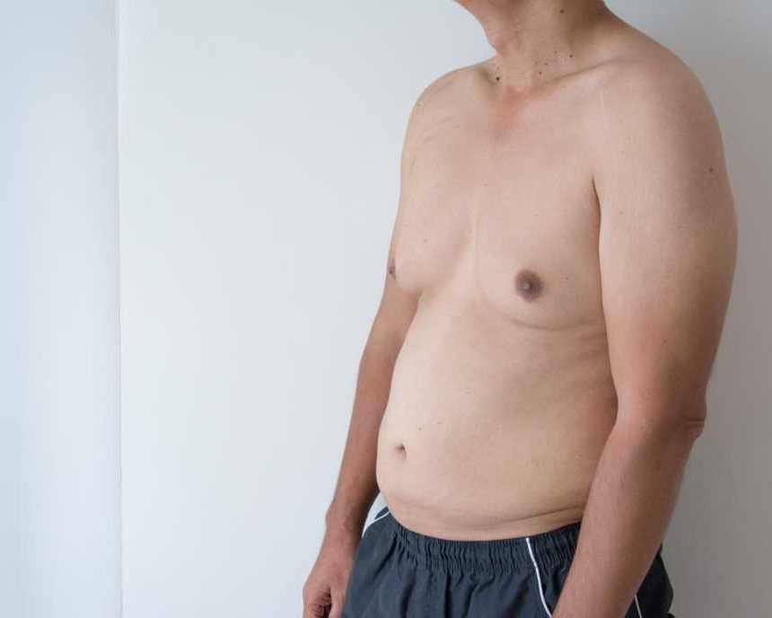 best-gynecomastia-surgery-in-mumbai-by-experienced-surgeons